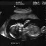 black and white ultrasound image of a fetus