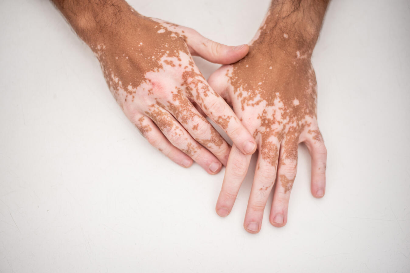 photograph of man's hands with vitiligo